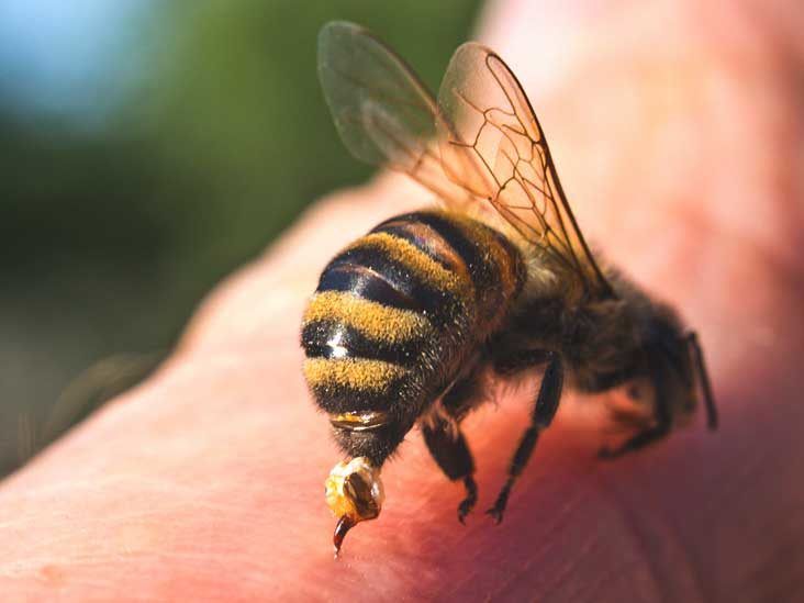 honey bee sting allergy