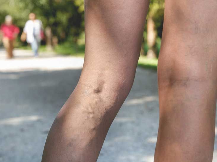 Compression Socks for Varicose Veins: Benefits, How They Work, and Choosing  the Right Pair
