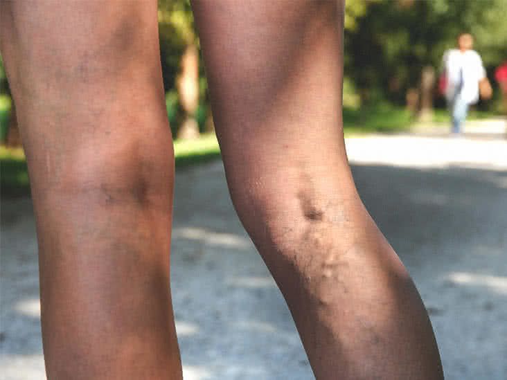 What Is the Treatment for Painful Varicose Veins?