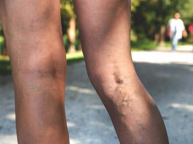 Varicose Vein Pain: What It Feels Like and Relief