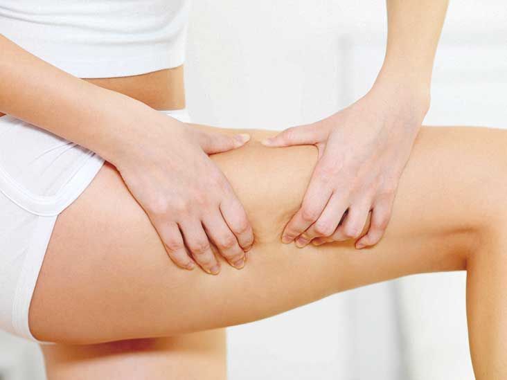 Cellulite treatments: What really works?