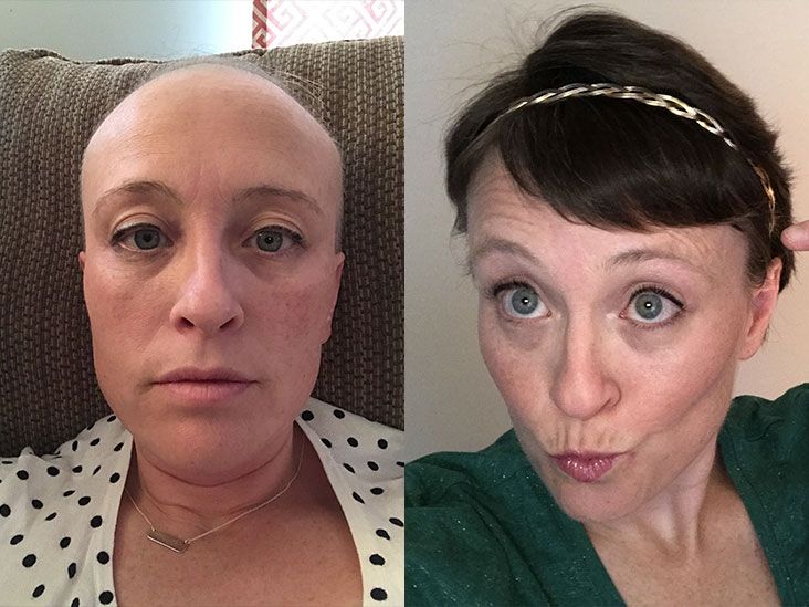 Hair Growth After Chemotherapy Pictures And The Process 
