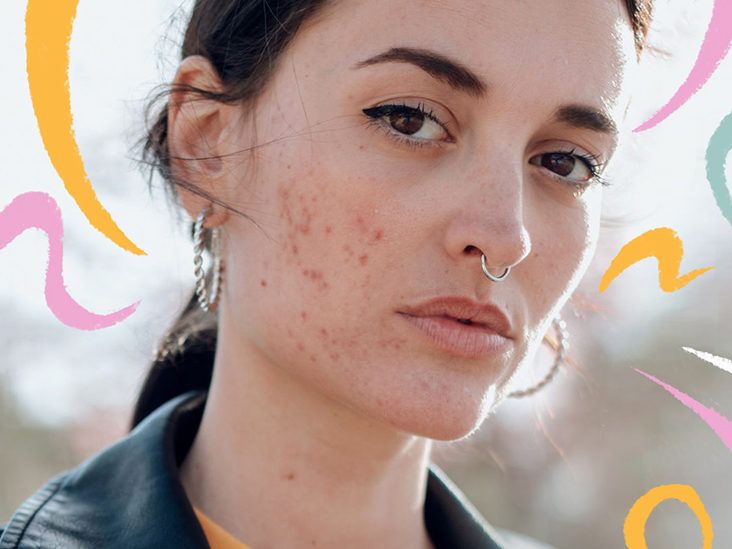 Opinion: Healing my inflamed, acne-ridden skin after coming off