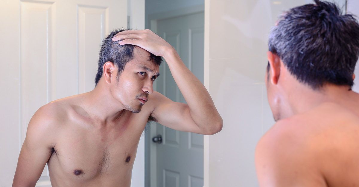 6 Signs of Male Pattern Baldness | Jonsson Protein