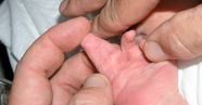 Webbing Of The Fingers Causes And Treatments Webbing Of The Fingers Causes And Treatments