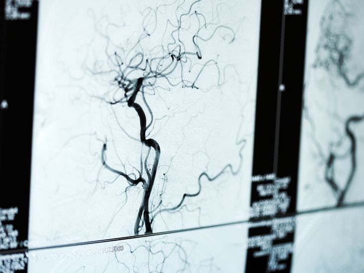 Arteriogram: types, procedure, and results