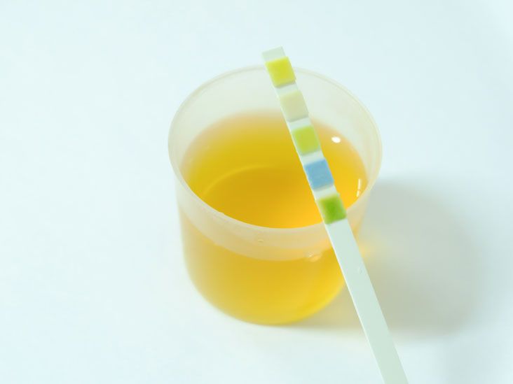 Urine Calcium Level Tests Purpose, Procedure, and Results