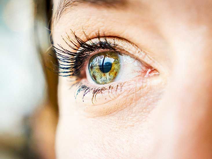 What Causes Puffy Eyes?