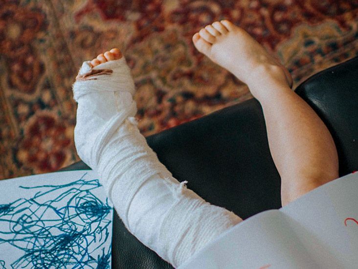 Broken Foot Symptoms: What to Expect