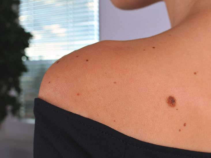Nevus Definition, Common Types, Photos, Diagnosis, and Treatment