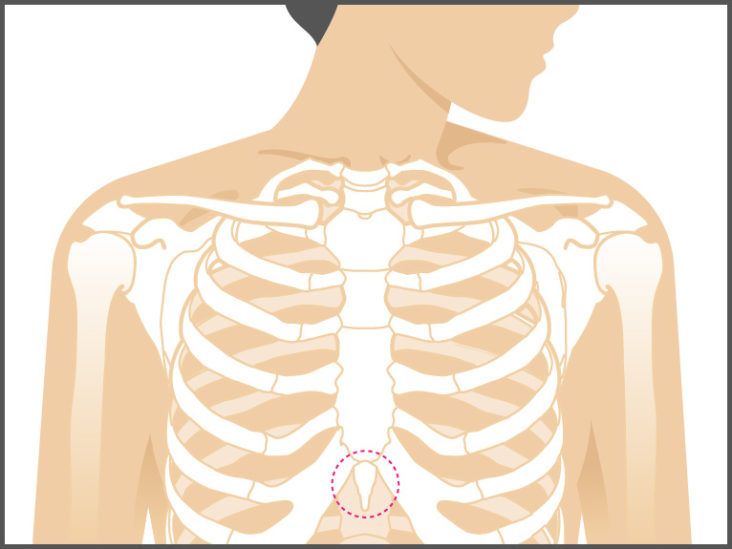 Wide gap in the upper part of the sternum covered with skin
