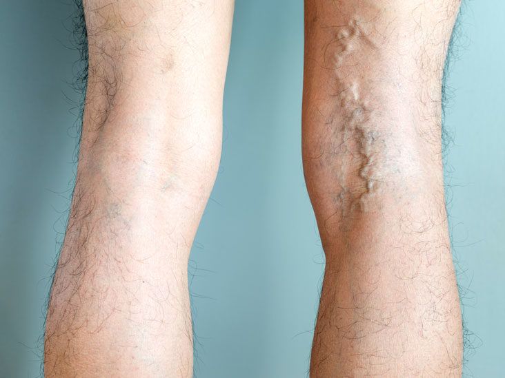 Treatments for varicose veins (III): the secrets of compression