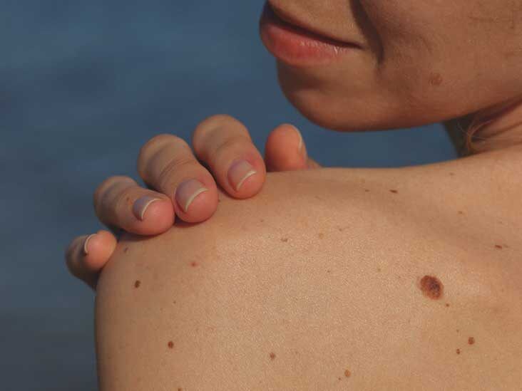 Breast rash. Is this shingles? : r/Dermatology