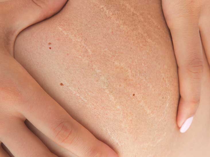 Purple Stretch Marks: Causes, Risk Factors, and Treatment
