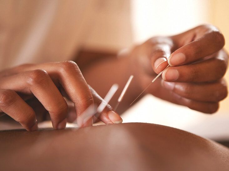 Acupuncture for Ulcerative Colitis: What to Know