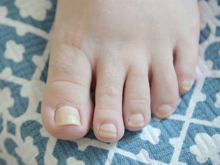 Evaluation of Nail Abnormalities | AAFP