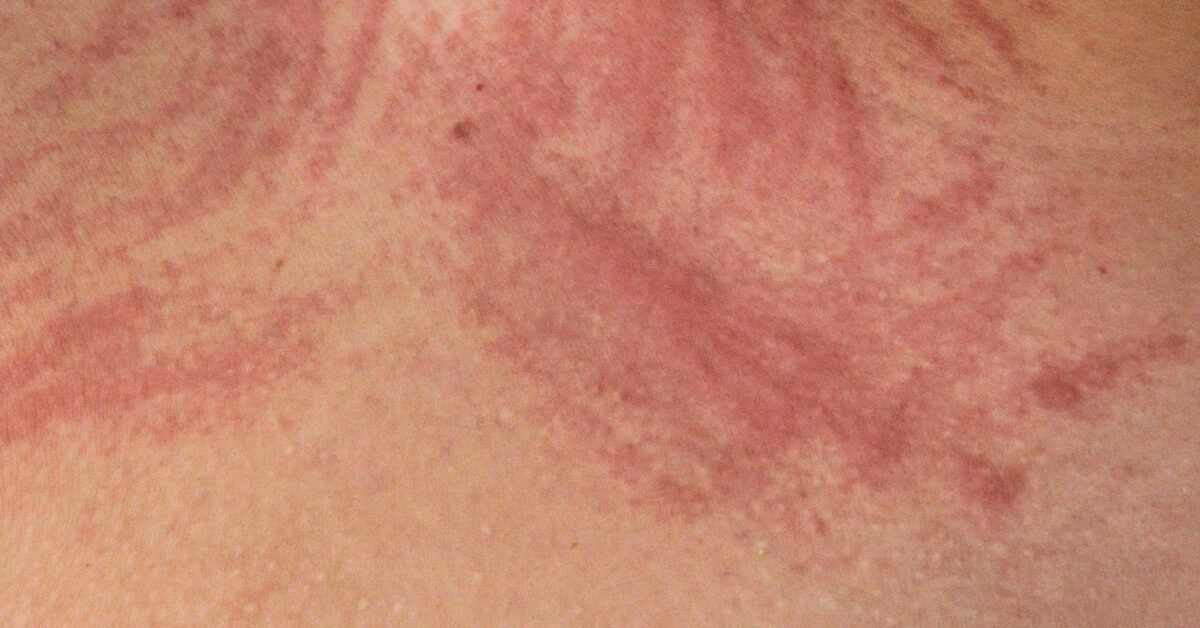 7 Types of Eczema: Symptoms, Causes & Treatment | Clinikally