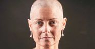 Breast Cancer Treatment And Hair Loss Prevention