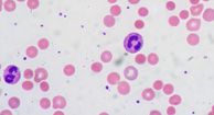 Idiopathic Autoimmune Hemolytic Anemia