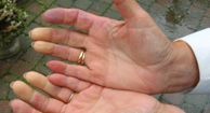 systemic scleroderma hands
