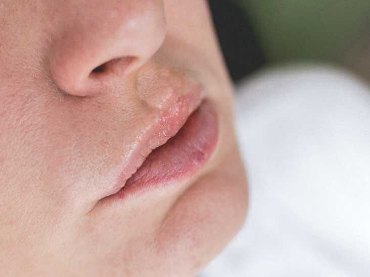 6 Causes of Swollen Lips