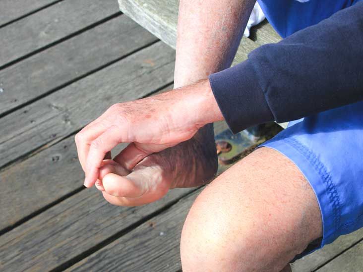 Skin Peeling Between Toes Causes, Treatment, and More