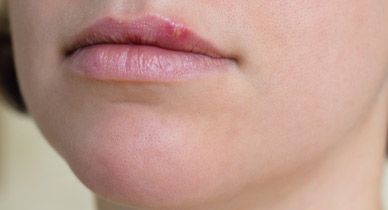 how to get rid of pimple on lip line