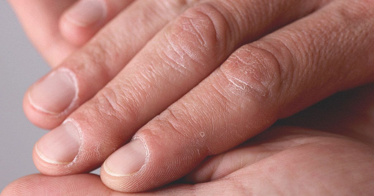 What is white spot on fingernails? | Vinmec