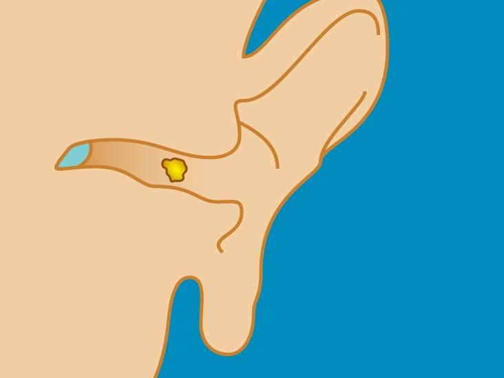 Earwax Color: Chart, Infection, Tarry Earwax, and More