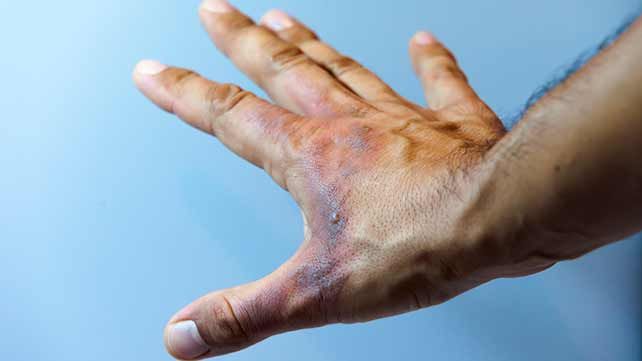 Chemical Burns: Causes, Symptoms, and Diagnosis
