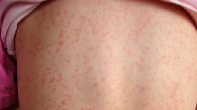 streptococcal pharyngitis rash