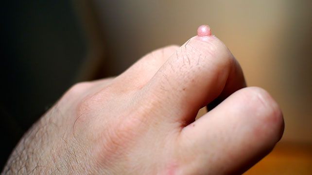 warts on fingers removal