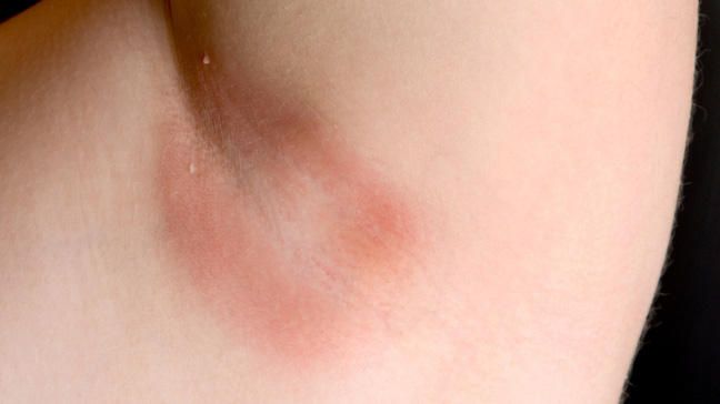 Non-itchy Rash between breasts (pic) - October 2015 Babies, Forums