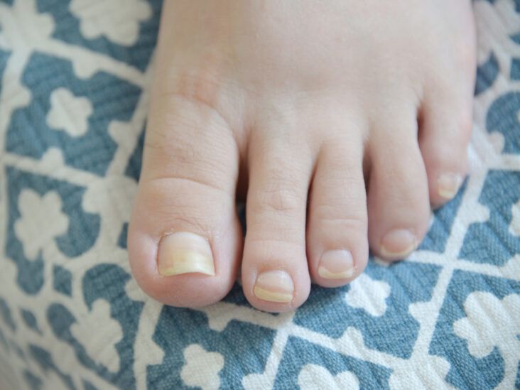 Ingrown Toenails are More than Uncomfortable - My Chicago Foot Expert