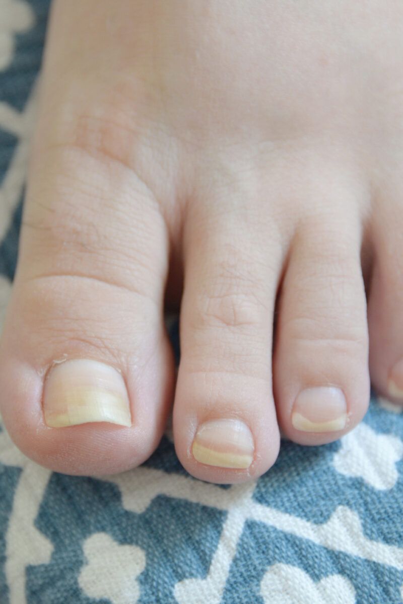 My wife has a toenail growing on top of her toenail : r/mildlyinteresting