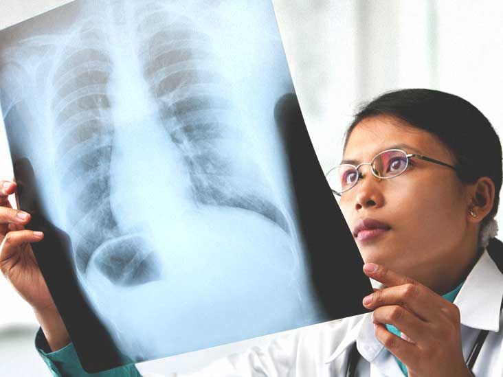 COPD XRay Pictures, Diagnosis, and More