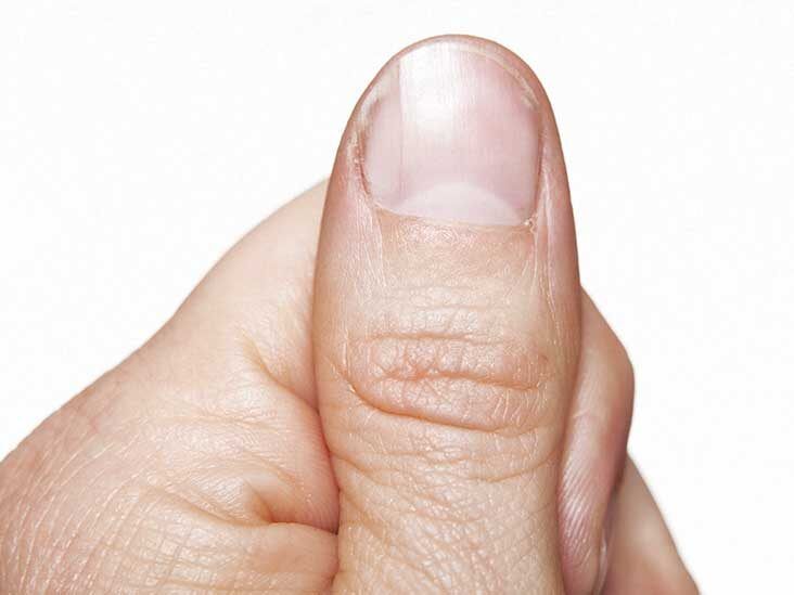 Painful nail with longitudinal erythronychia  MDedge Family Medicine