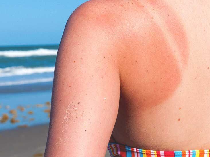 Natural and home remedies for sunburns 