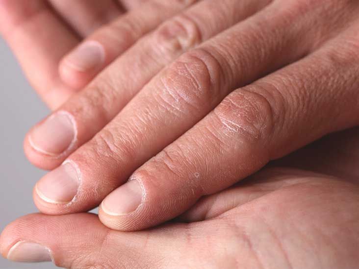 Ridges in Fingernails Symptoms, Causes, and Treatments