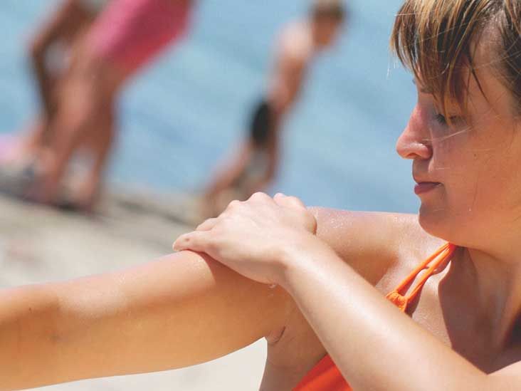 Sunburn Blisters Symptoms, Treatments, and Complications