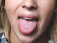 Sore Tongue 17 Possible Causes Healthline