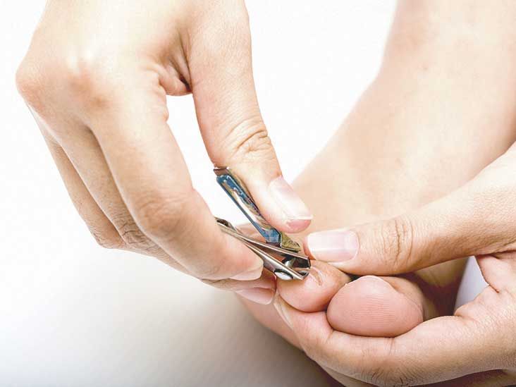 Painful thickened toenails — Mackay Ingrown Toenail Clinic