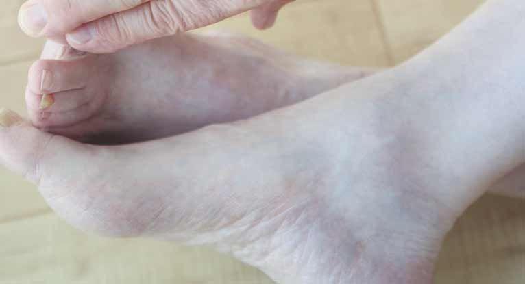 Fungal Nail Infections: Symptoms, Causes & Treatment