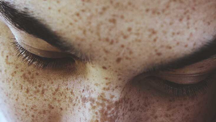 How to Get Rid of Freckles: 7 Ways