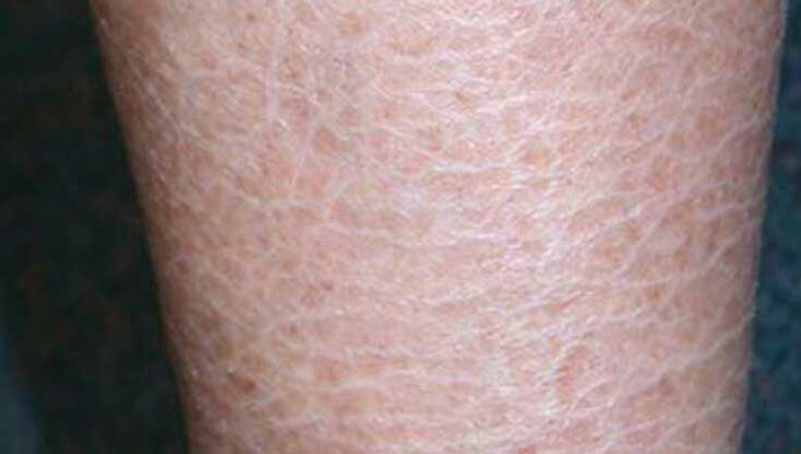 severe ichthyosis vulgaris