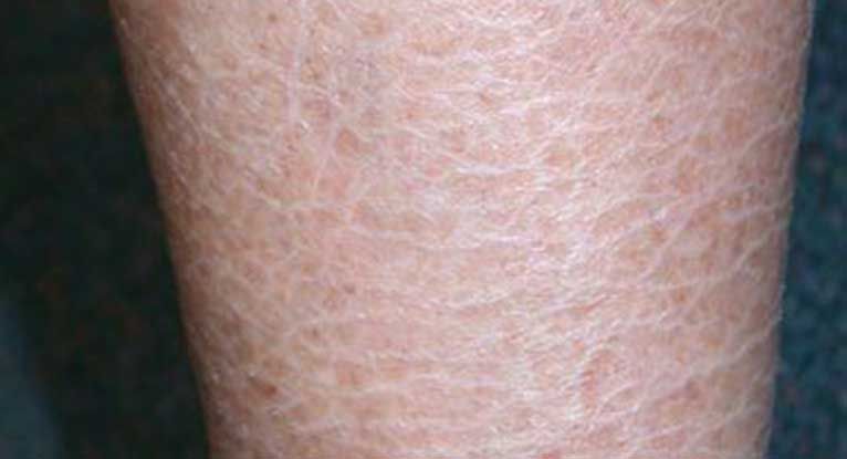Heat rash - Symptoms & causes - Mayo Clinic