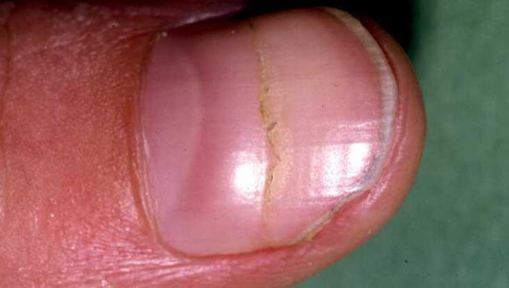 Top 147+ common nail diseases super hot