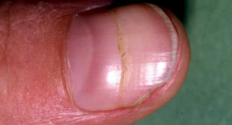 Woman shares warning that black line on nail could be sign of cancer   The Independent  The Independent
