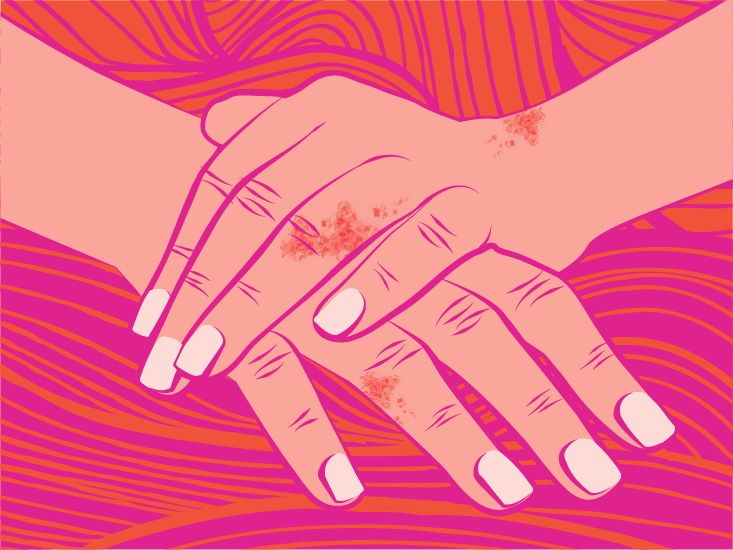 Psoriasis: Facts, Statistics, and You