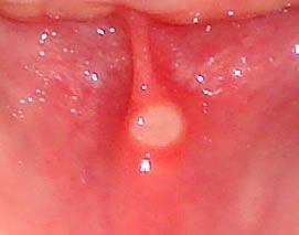 canker sore on upper gum